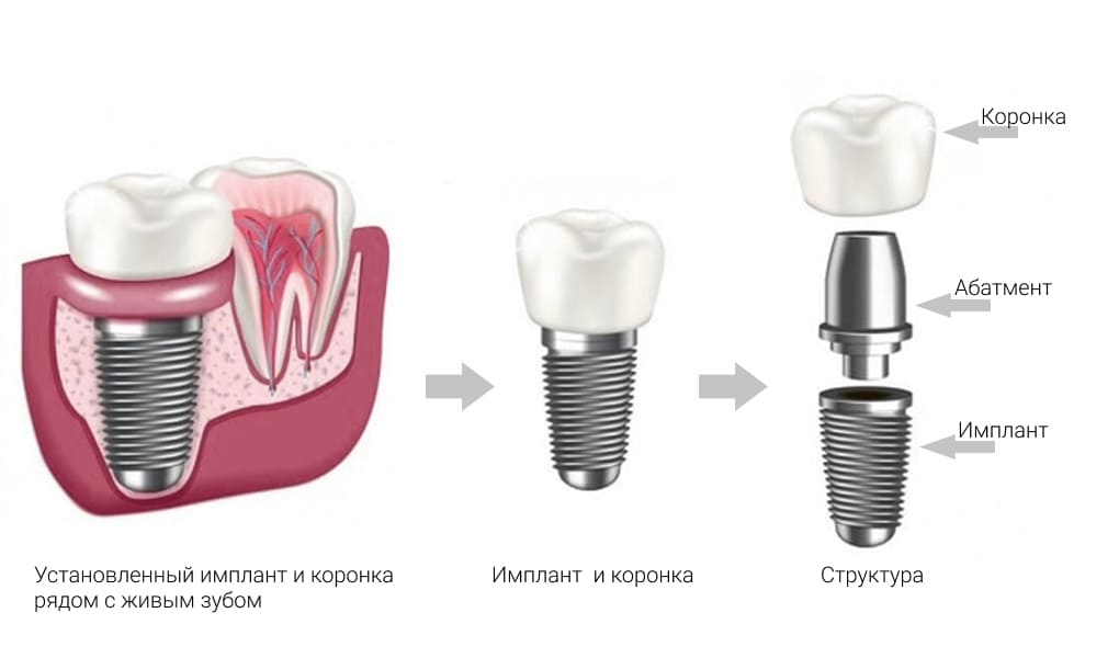 Коронка на имплант
